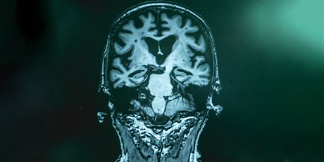 Стресс, плохое образование и еще 8 факторов, которые повышают риск Альцгеймера