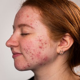 Ученые создали вакцины, которые навсегда избавляют от акне