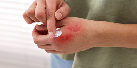 В соцсетях вирусится опасный тренд: зумеры прожигают себе руки дезодорантами