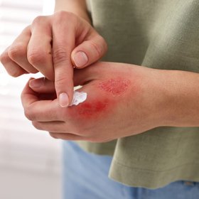 В соцсетях вирусится опасный тренд: зумеры прожигают себе руки дезодорантами