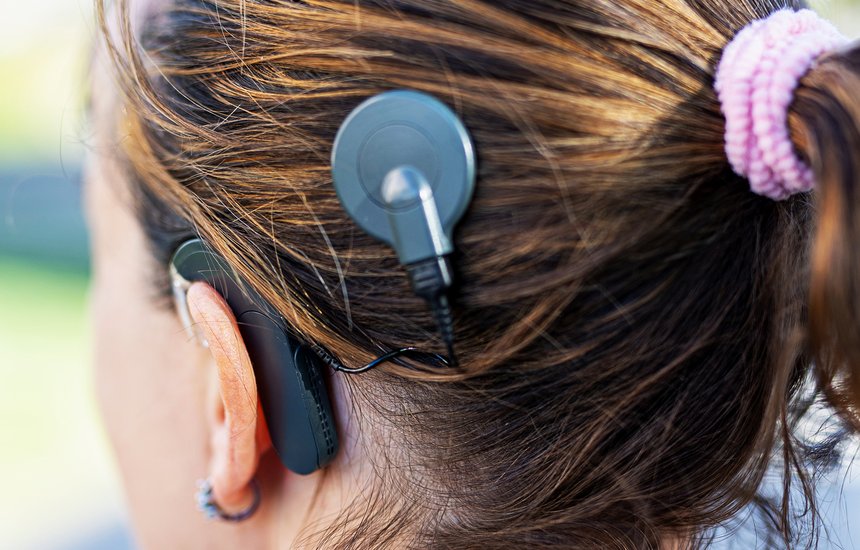 Кохлеарный имплантат