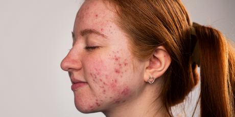 Ученые создали вакцины, которые навсегда избавляют от акне